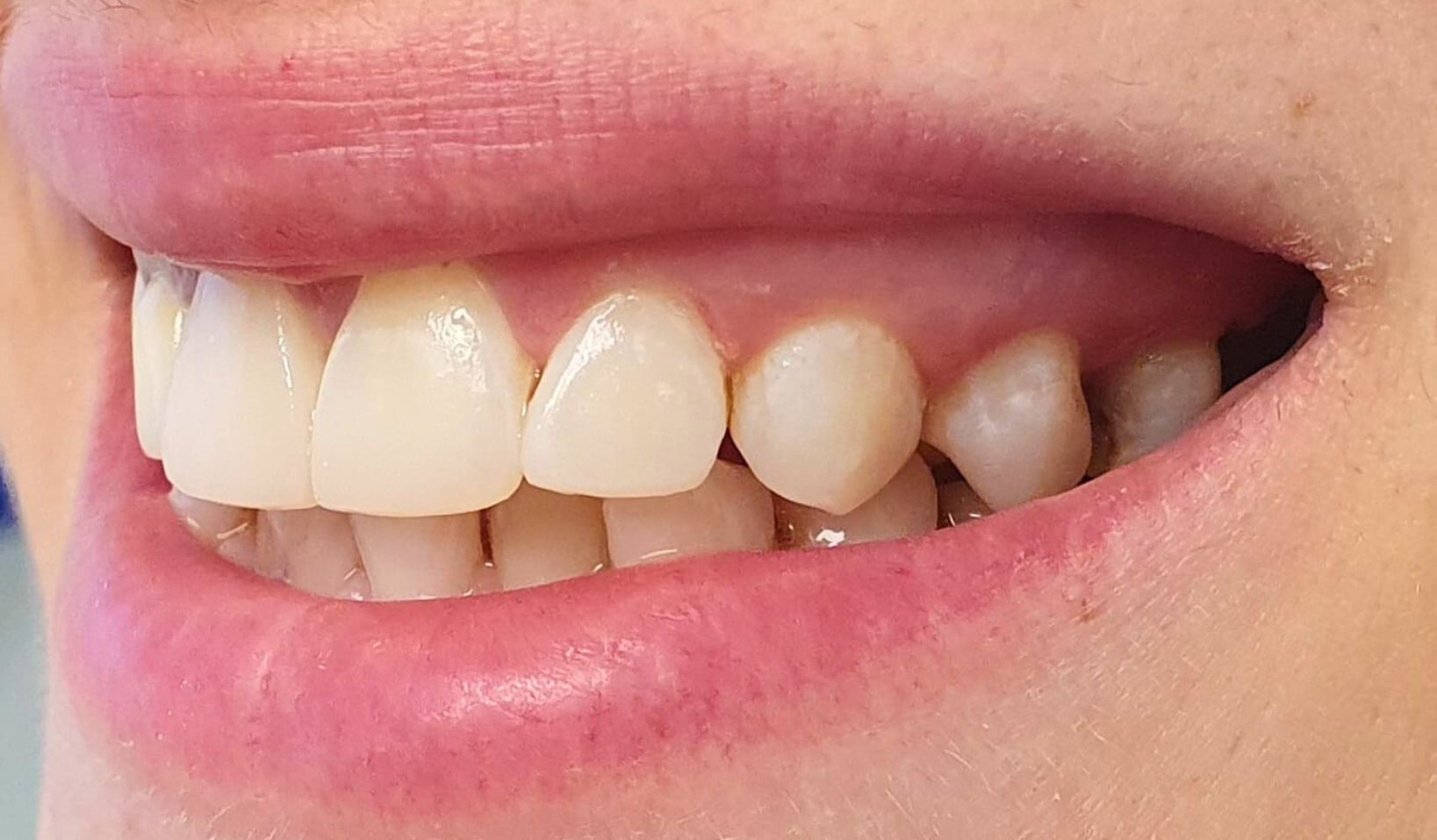 Composite Bonding Dental Art Implant Clinics